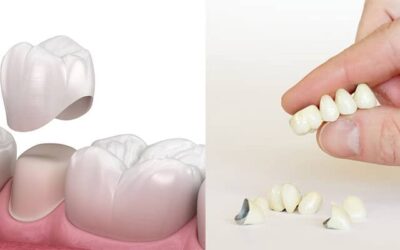 سفید کردن و تعمیر کردن دندان های مصنوعی