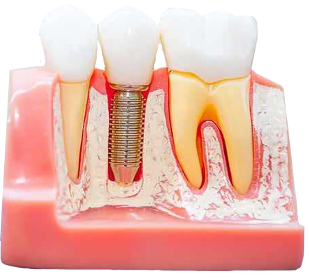 ایمپلنت چیست ؟