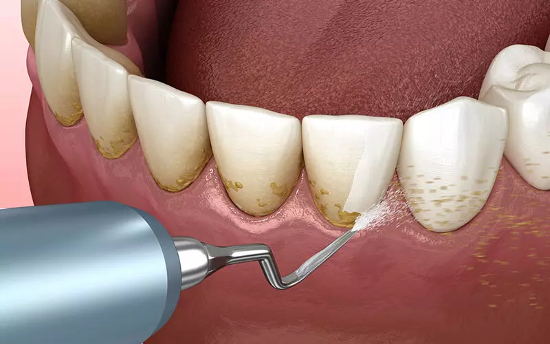 چه مدت بعد از کشیدن دندان میتوان دندان مصنوعی گذاشت ؟