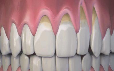 درمان تحلیل لثه : چگونه شکاف بین دندان و لثه را پر کنیم ؟