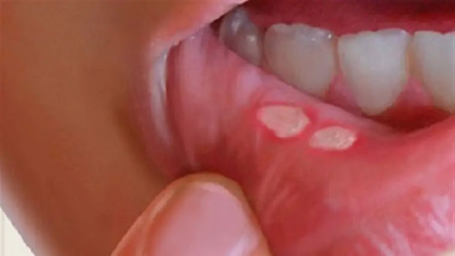 زخم دهان ناشی از دندان مصنوعی